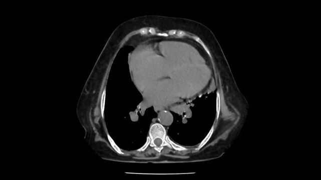 HRCT chest scan lung window axial view showing pulmonary anatomy