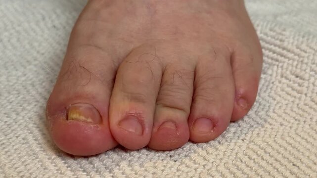 Onychomycosis. Dangerous fungal infection of human toenails on a white background at the doctor. Disease and detachment of the nail plate. Close-up
