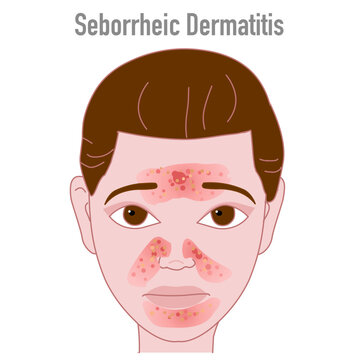 Seborrheic dermatitis on the woman face. This condition causes red, flaky, greasy, and itchy girl skin. Illustration vector	