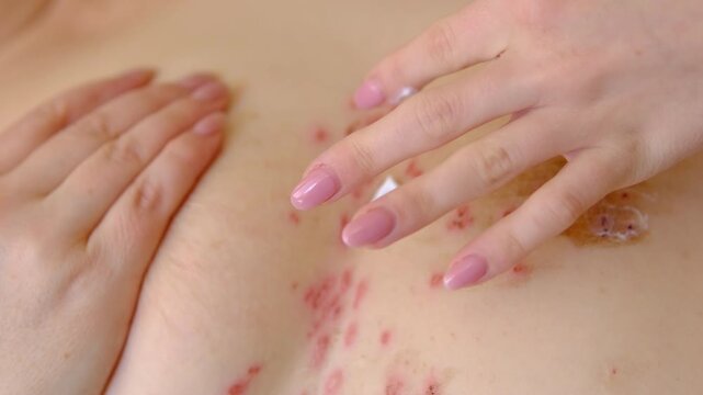 Applying healing cream on skin irritation under breast with fingertip care treatment