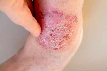 Fototapeta premium doctor treats large healing wound from lower leg with scars adult female patient, redness, diabetes disease, scarring skin, medical care, human tissue regeneration, hives and other skin manifestations