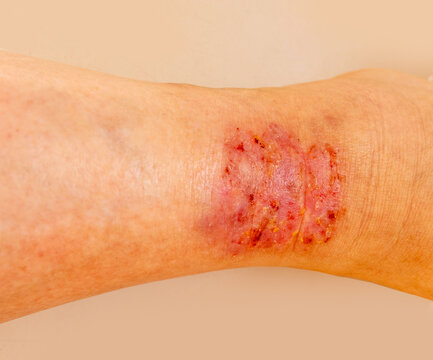 close-up injured female limb with damaged reddened skin, scratches, trophic wound on painful female leg, medical concept, chronic condition, dermatological disorder, skin problem, affected area