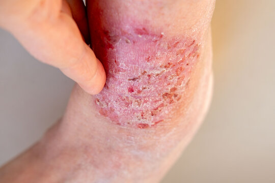 doctor treats large healing wound from lower leg with scars adult female patient, redness, diabetes disease, scarring skin, medical care, human tissue regeneration, hives and other skin manifestations