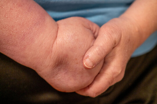 severely swollen paralyzed hand, edema and inflammation, clinical observation lymphatic, vascular disorder, healthcare, palliative settings disabled individuals managing long-term physical impairment