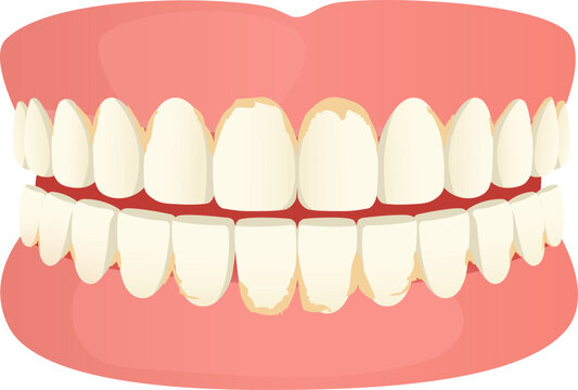 Dental Calculus and Plaque on Teeth Illustration