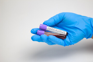 Obraz premium Hand in blue glove holds two test tubes. Blood samples labeled for viral testing. White background emphasizes medical precision. No faces show emotion, focus is clinical. Ideal for health, research