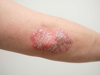 Fototapeta premium Clinical Dermatology Close-up – Psoriasis Plaque on Elbow