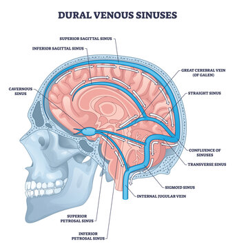 Dural venous sinuses overview illustrates brain cross section with superior sagittal sinus, transverse sinus, and internal jugular vein flow pathways. Outline diagram