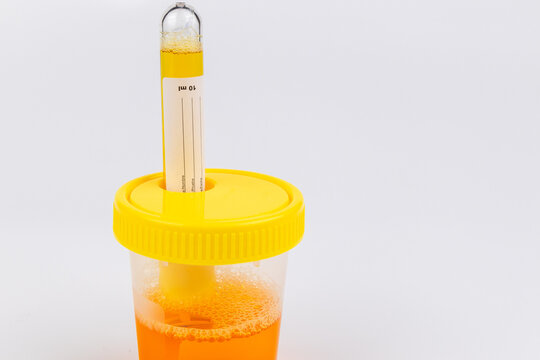 Medical vacuum test tube next to a plastic container filled with a yellow liquid urine sample isolated on a clean white background
