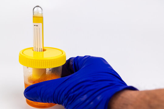 Close up of a hand in blue glove inserting a vacuum test tube inside a urine sample collection container over a white background