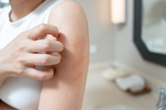skin problem and beauty. Young woman scratch body has itchy skin from skin allergic, steroid allergy, sensitive skin, red from sunburn, chemical allergy, rash, insect bites, Seborrheic Dermatitis.
