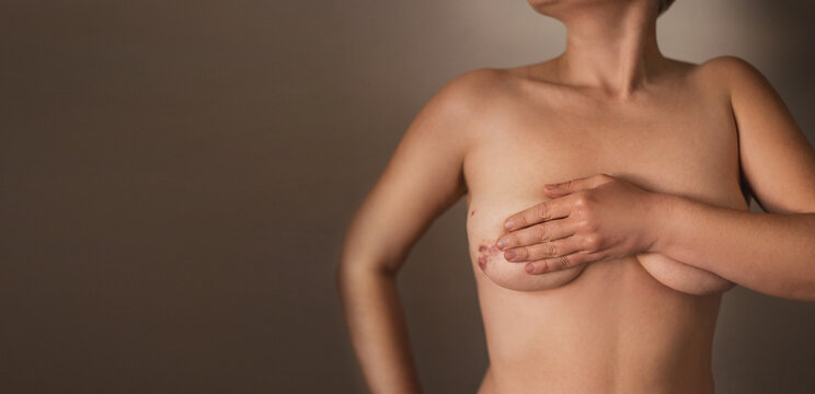 woman shows bruise and scar from core biopsy, breast cancer diagnosis and treatment. Close-up, no face,  female hands covering her breast. Breast cancer treatment, diagnostic stage. copy space banner