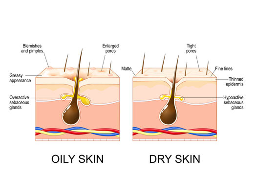 Oily skin and dry skin comparison. Skin types.