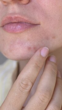 Closeup of woman inspecting and touching chin skin for acne blemishes showing skin problem self-check routine. Skin concern footage ideal for dermatology advertising, acne treatment, skincare problem