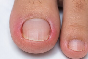 Fototapeta premium Ingrown Toenail on Big Toe