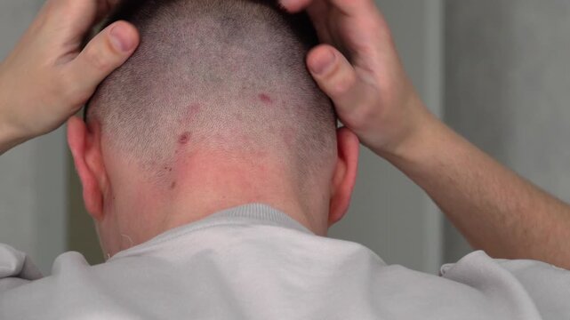 A man scratches the back of his closely shaved head.
A man with a rash and rash on his neck.
