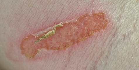 Fototapeta premium Burn injury on caucasian arm beginning to heal. Medical condition with redness and swelling.