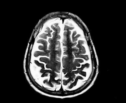 Magnetic resonance image (MRI) of the brain. MRI scan of human brain axial view with black background.