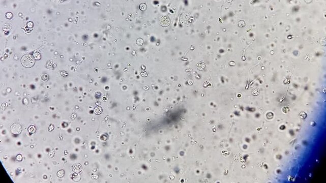 Oligozoospermia and asthenozoospermia with evidance of infection. Plenty of pus cells are seen. Microscopic footage of abnormal sparm count.