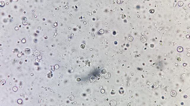 Oligozoospermia and asthenozoospermia with evidance of infection. Plenty of pus cells are seen. Microscopic footage of abnormal sparm count.