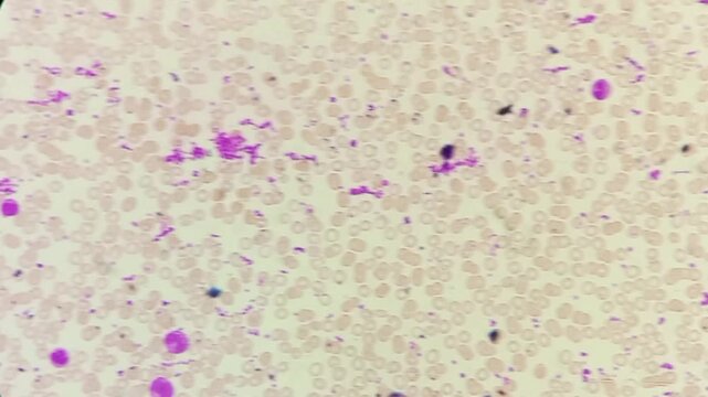 Normocytic normochromic anaemia with leucocytosis and thrombocytosis. Microscopic footage of blood cells. 