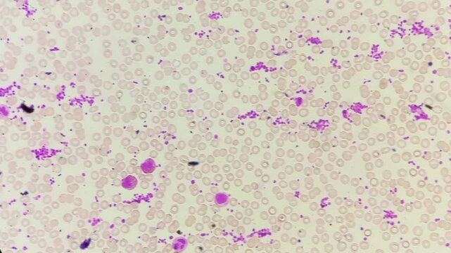 Normocytic normochromic anaemia with leucocytosis and thrombocytosis. Microscopic footage of blood cells. 