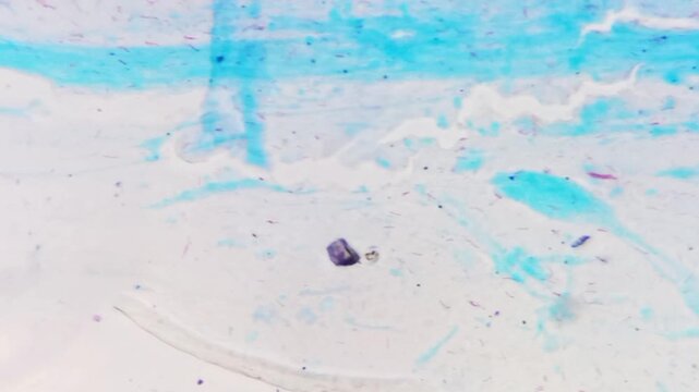 Sputum smear AFB stain microscopic footage plenty of mycobacterium tuberculosis bacteria. Acid Fast Bacilli (AFB) positive (4+).