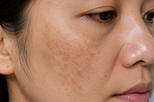 Close Up of Melasma on Asian Woman Face, Realistic Hyperpigmentation and Uneven Skin Tone, Dermatology Concept