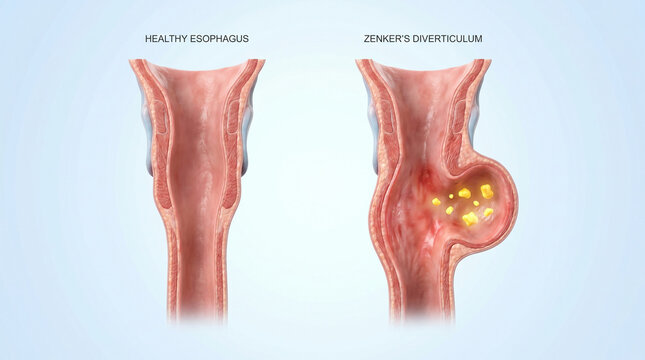 Zenkers Diverticulum Esophageal Pouch Medical Anatomy Diagram