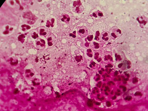 Intracellular Neisseria gonorrhoeae bacteria with gram staining, viewed under a microscope.	
