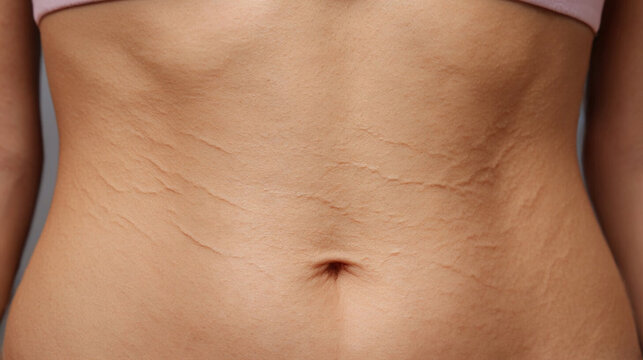 A thin female waist with stretch marks after weight loss