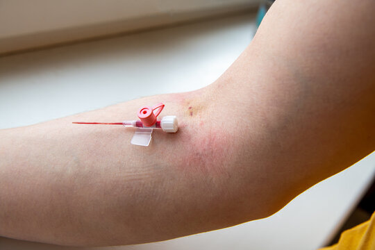 Human arm with visible marks immediately after intravenous cannula needle removal