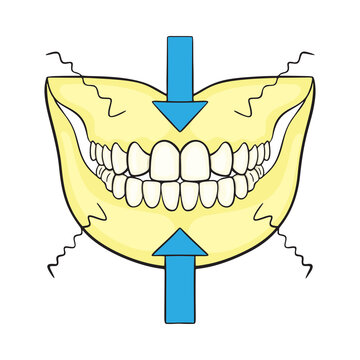 Bruxism