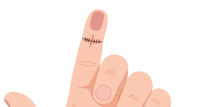 Injured Finger with Surgical Sutures: Medical Treatment and Healing Illustration