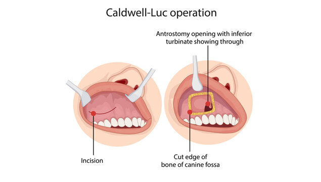 Caldwell-Luc Operation
Surgical illustration demonstrating the Caldwell-Luc procedure, including canine fossa access and creation of an inferior meatal antrostomy for maxillary sinus drainage.
