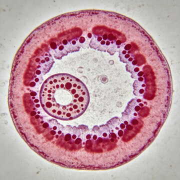 Original Giemsa stained thin blood film of Plasmodium vivax ring form trophozoite, enlarged infected red blood cell with Sch&uuml;ffner's dots, authentic malaria specimen, parasitology