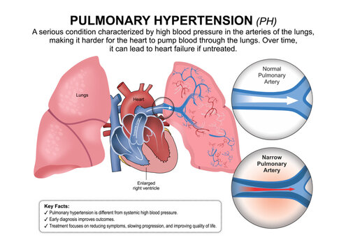 Pulmonary Hypertension (PH) Flashcard Illustration