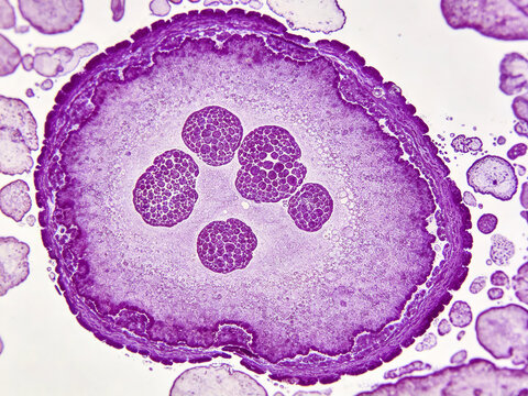 Original Giemsa stained micrograph of human plasma cell Mott cell, characteristic cytoplasmic Russell bodies, abnormal plasma cell, authentic bone marrow specimen