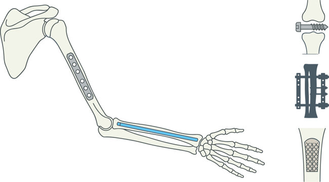 Forearm Bone Fracture Fixation Anatomy Illustration with Orthopedic Implant Plate, Skeletal Structure, Surgical Treatment, and Medical Education Diagram