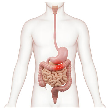 Human Digestive System with Inflammation in Stomach and Intestines