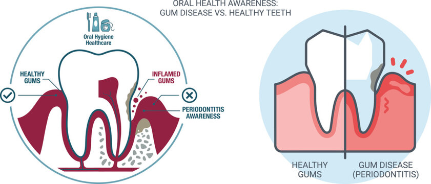 Oral Health Awareness Infographic Comparing Healthy Gums and Gum Disease Periodontitis Vector Illustration