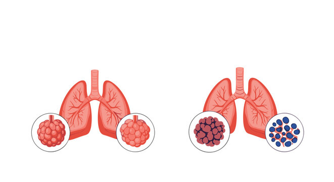 Medical comparison of healthy lungs and lungs with abnormal cell clusters representing cancer or a severe infection.