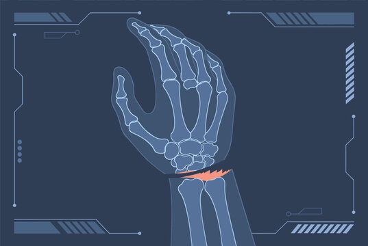 Medical x-ray imaging reveals a clear fracture in the radius bone of a human wrist joint for diagnostic analysis and medical treatment.