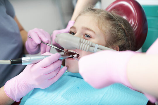 Little girl is comfortable to treat her teeth under superficial sedation. Treatment of children's teeth with nitrous oxide. Milk teeth treatment. Little girl in dentist's office.
