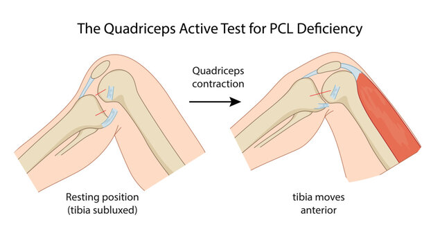 The Quadriceps Active Test for PCL Deficiency, emonstrating the Quadriceps Active Test, used to assess posterior cruciate ligament (PCL) deficiency in the knee.