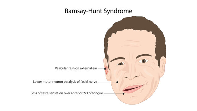 Ramsay Hunt Syndrome and Facial Nerve Palsy, characteristic clinical features of Ramsay Hunt syndrome, including facial paralysis, inability to close the eye, and drooping of the mouth.