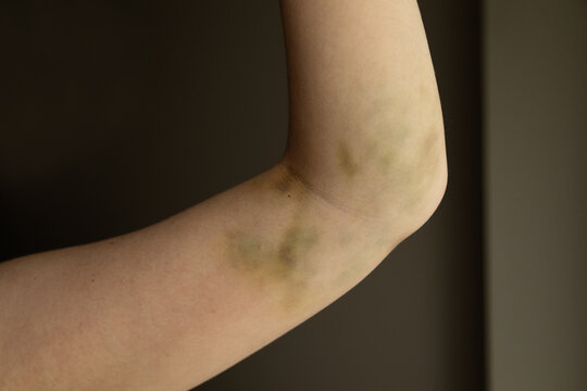 Close-up of a healing bruise and hematoma on the inner arm near the elbow following a blood draw or medical procedure. Green and yellow discolouration during the recovery stage.