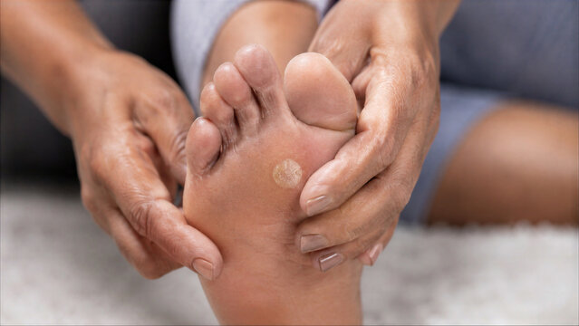Close-up of a person examining a plantar wart on the sole of their foot