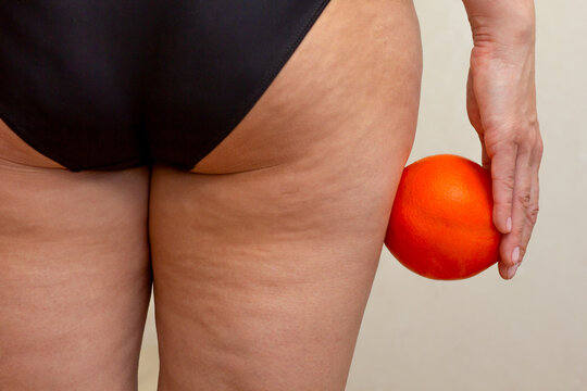 A close up of a womans thighs displaying cellulite dimples, with an orange fruit held in hand to visually illustrate the orange peel skin texture