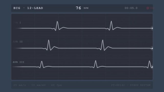 Medical ECG Monitor Display with Heart Rate and Sinus Rhythm